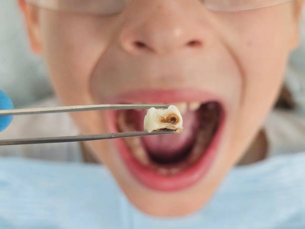 Best Knocked-Out Tooth (Avulsed Tooth) Treatment in Brookside, AL